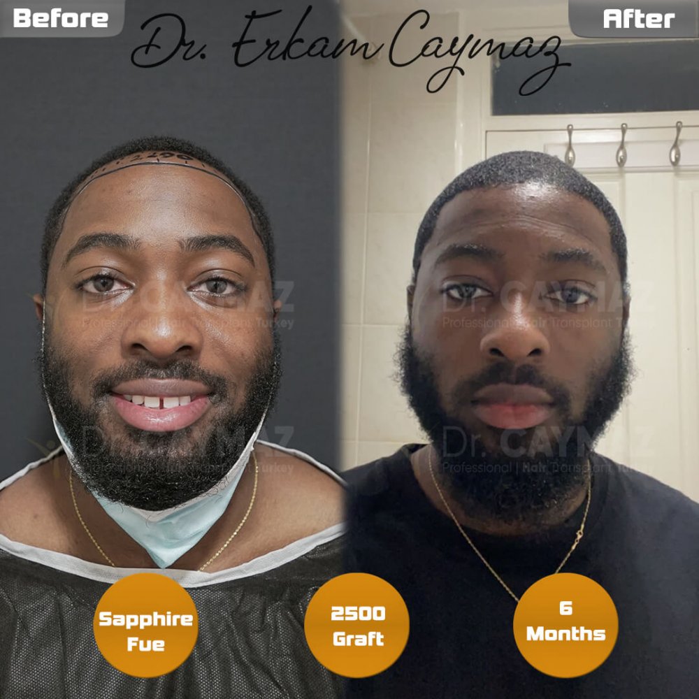 Mr.Msowoya - Afro American - 2500 Graft - 6 Months — hair transplant before & after — frontal, 2,500 grafts, Sapphire FUE, 6 months post-op, Norwood 2 — Dr. Erkam Caymaz, Istanbul