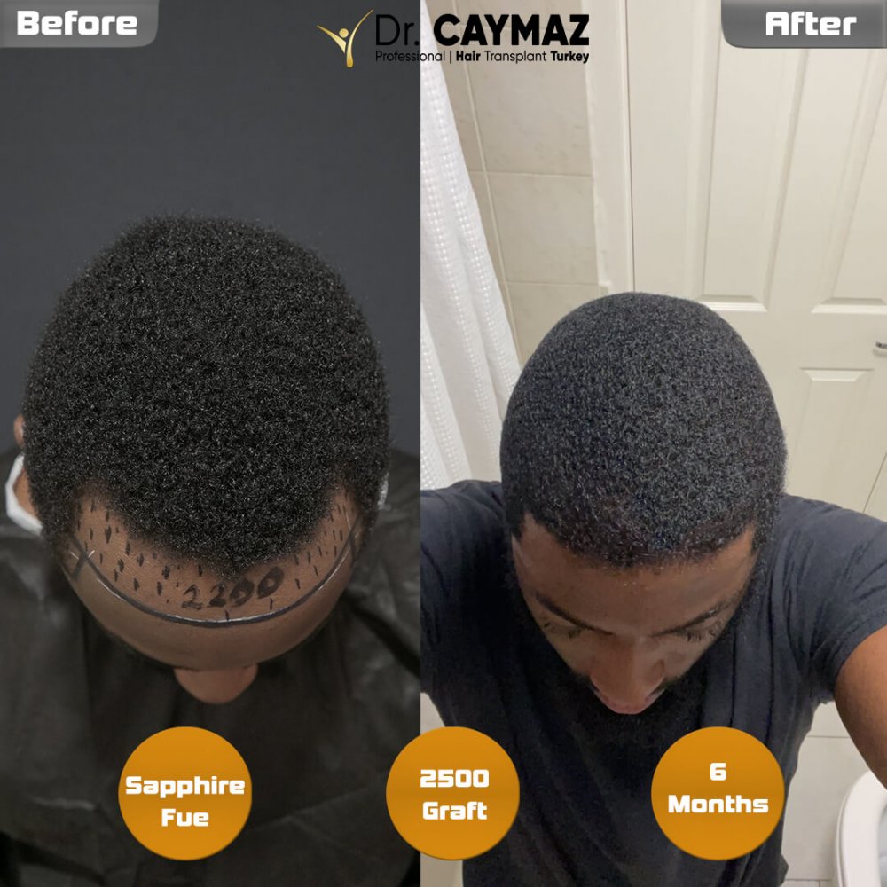 Mr.Msowoya - Afro American - 2500 Graft - 6 Months — hair transplant before & after — frontal, 2,500 grafts, Sapphire FUE, 6 months post-op, Norwood 2 — Dr. Erkam Caymaz, Istanbul