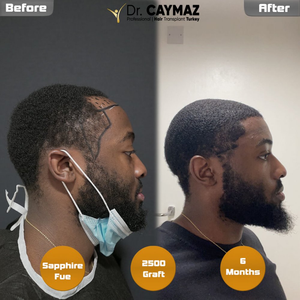 Mr.Msowoya - Afro American - 2500 Graft - 6 Months — hair transplant before & after — frontal, 2,500 grafts, Sapphire FUE, 6 months post-op, Norwood 2 — Dr. Erkam Caymaz, Istanbul