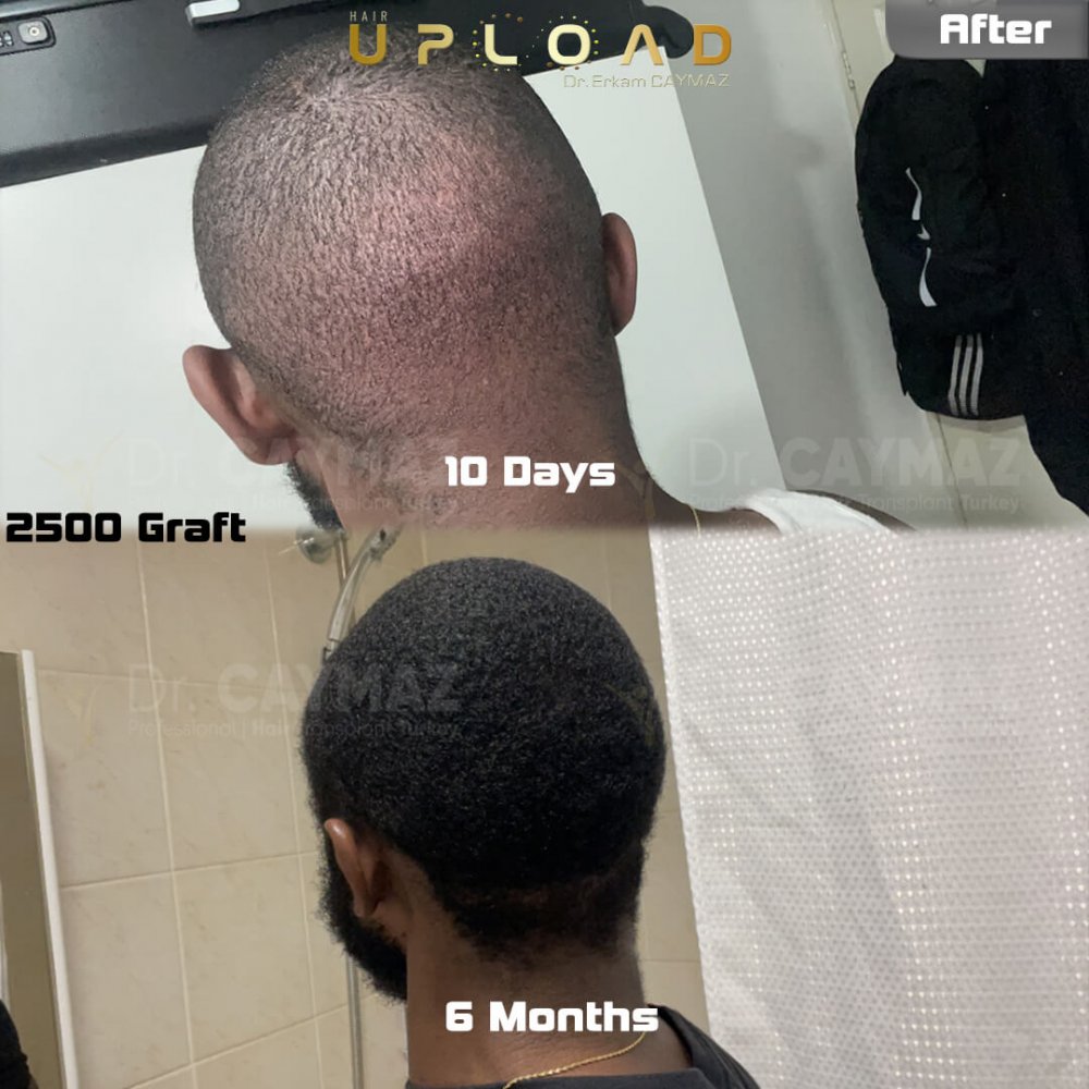 Mr.Msowoya - Afro American - 2500 Graft - 6 Months — hair transplant before & after — frontal, 2,500 grafts, Sapphire FUE, 6 months post-op, Norwood 2 — Dr. Erkam Caymaz, Istanbul