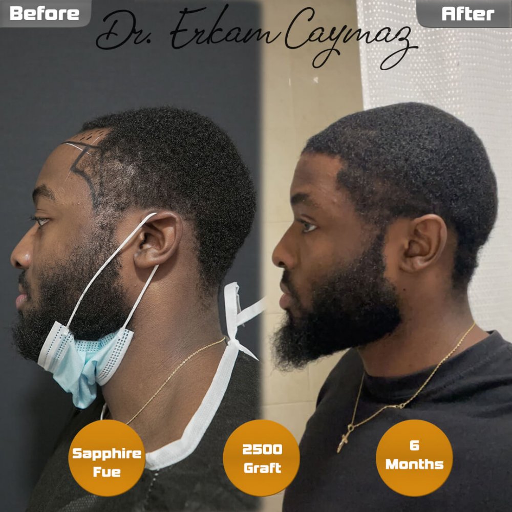 Mr.Msowoya - Afro American - 2500 Graft - 6 Months — hair transplant before & after — frontal, 2,500 grafts, Sapphire FUE, 6 months post-op, Norwood 2 — Dr. Erkam Caymaz, Istanbul