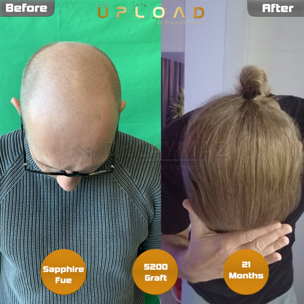 Hair transplant before & after result — frontal, parte superior, corona, 5,200 grafts, Sapphire FUE, 24 months post-op, Norwood 6 — Dr. Erkam Caymaz, Istanbul