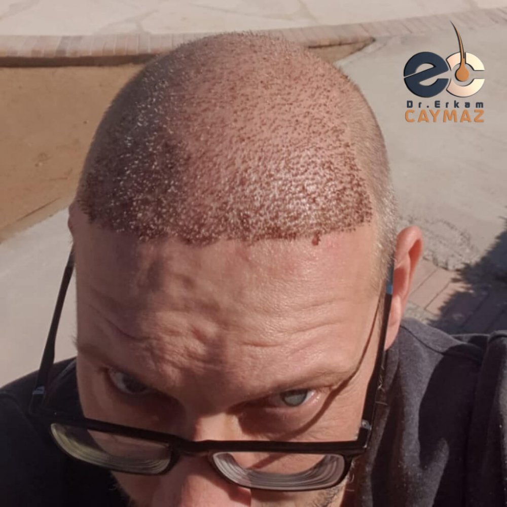 Hair transplant before & after result — frontal, parte superior, corona, 5,200 grafts, Sapphire FUE, 24 months post-op, Norwood 6 — Dr. Erkam Caymaz, Istanbul