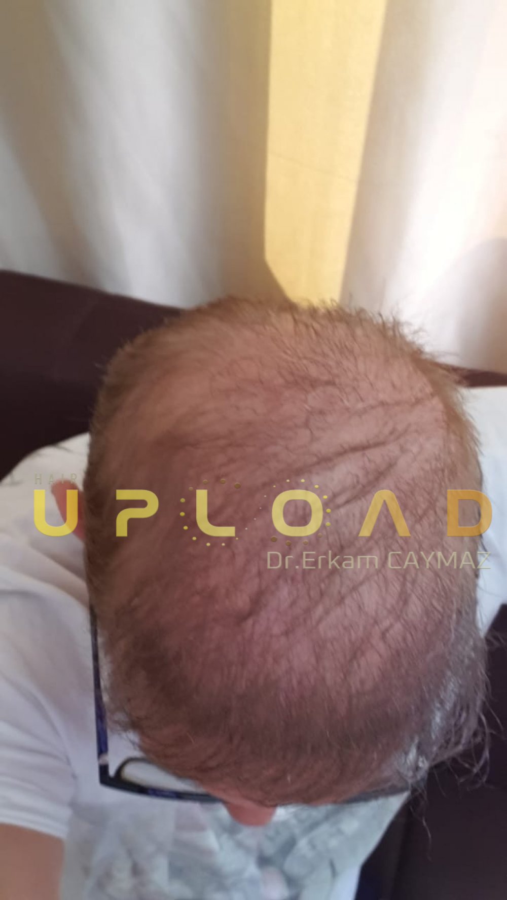 Hair transplant before & after result — frontal, parte superior, corona, 5,200 grafts, Sapphire FUE, 24 months post-op, Norwood 6 — Dr. Erkam Caymaz, Istanbul