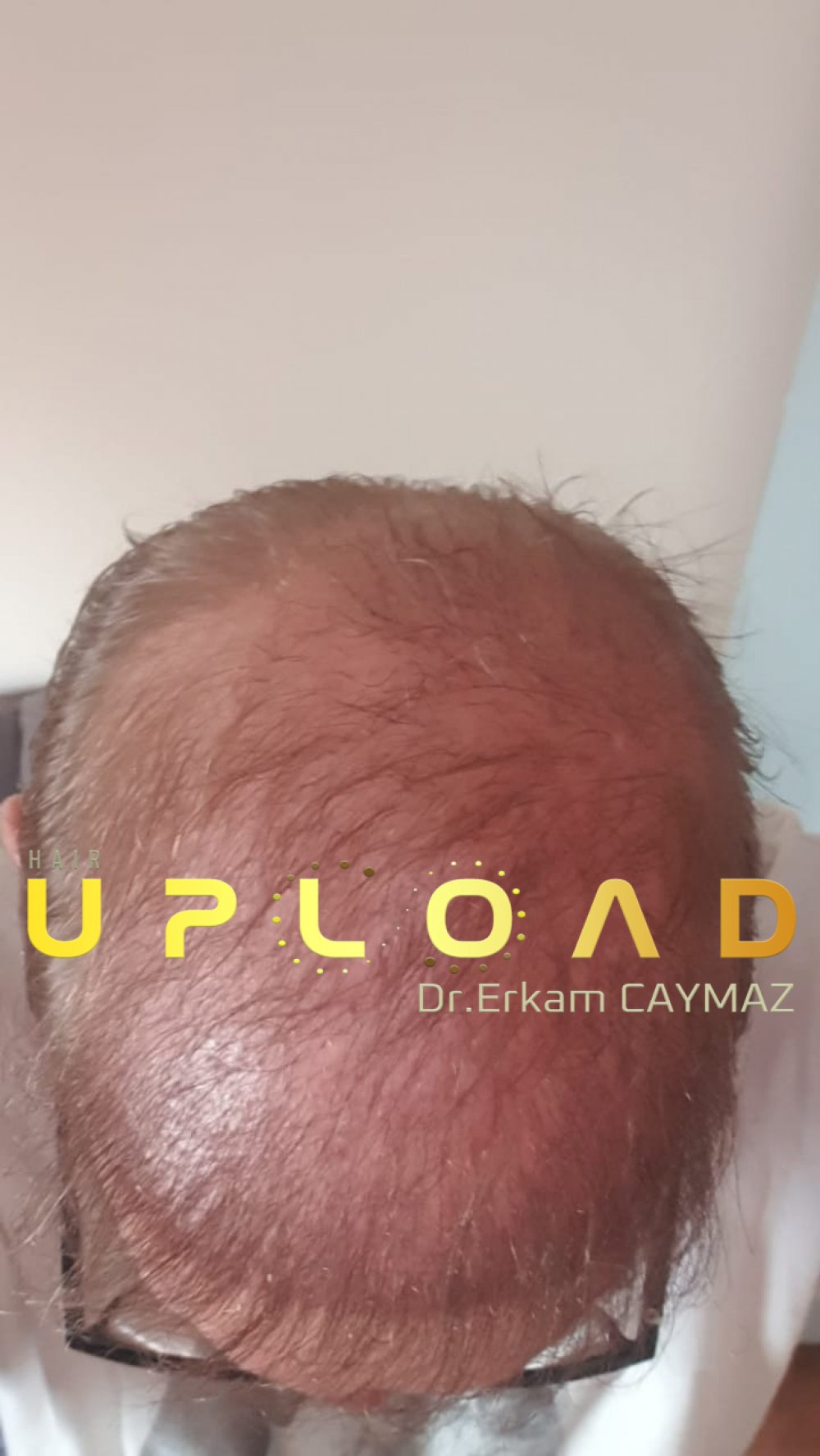Hair transplant before & after result — frontal, parte superior, corona, 5,200 grafts, Sapphire FUE, 24 months post-op, Norwood 6 — Dr. Erkam Caymaz, Istanbul
