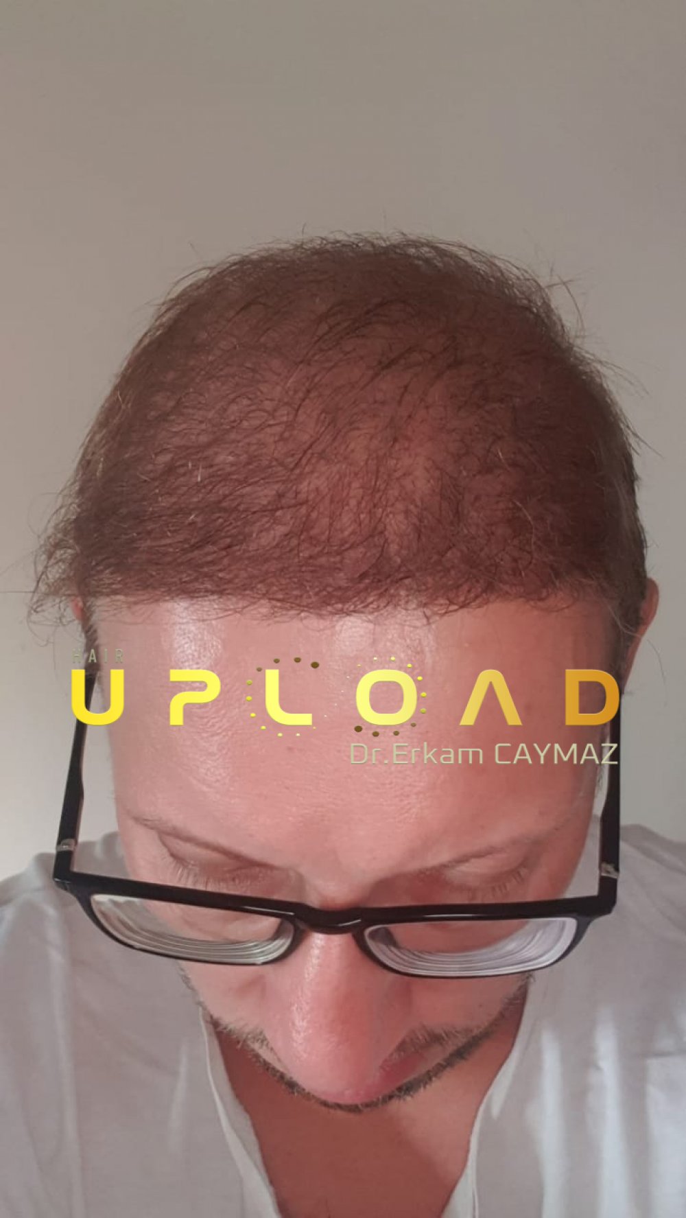 Hair transplant before & after result — frontal, parte superior, corona, 5,200 grafts, Sapphire FUE, 24 months post-op, Norwood 6 — Dr. Erkam Caymaz, Istanbul
