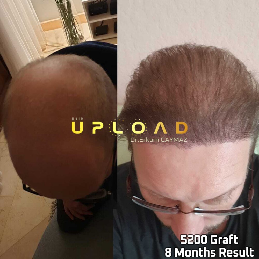 Hair transplant before & after result — frontal, parte superior, corona, 5,200 grafts, Sapphire FUE, 24 months post-op, Norwood 6 — Dr. Erkam Caymaz, Istanbul
