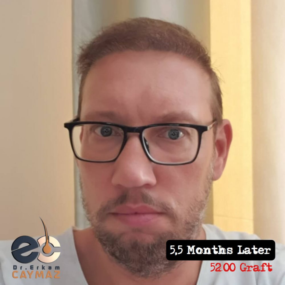 Hair transplant before & after result — frontal, parte superior, corona, 5,200 grafts, Sapphire FUE, 24 months post-op, Norwood 6 — Dr. Erkam Caymaz, Istanbul