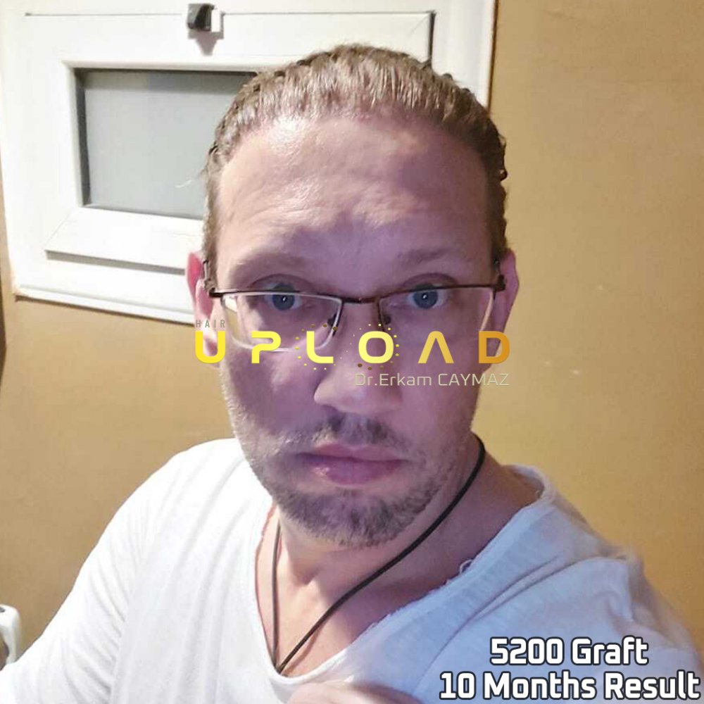 Hair transplant before & after result — frontal, parte superior, corona, 5,200 grafts, Sapphire FUE, 24 months post-op, Norwood 6 — Dr. Erkam Caymaz, Istanbul