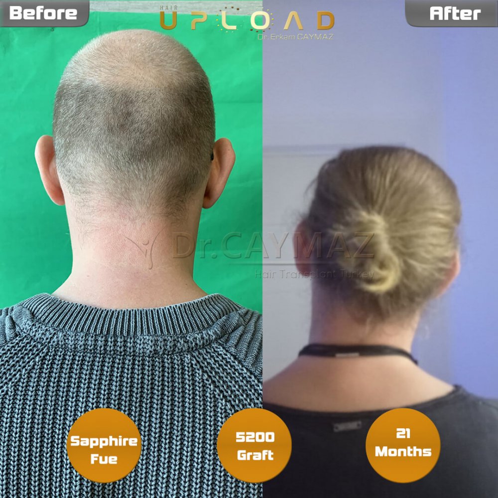 Hair transplant before & after result — frontal, parte superior, corona, 5,200 grafts, Sapphire FUE, 24 months post-op, Norwood 6 — Dr. Erkam Caymaz, Istanbul