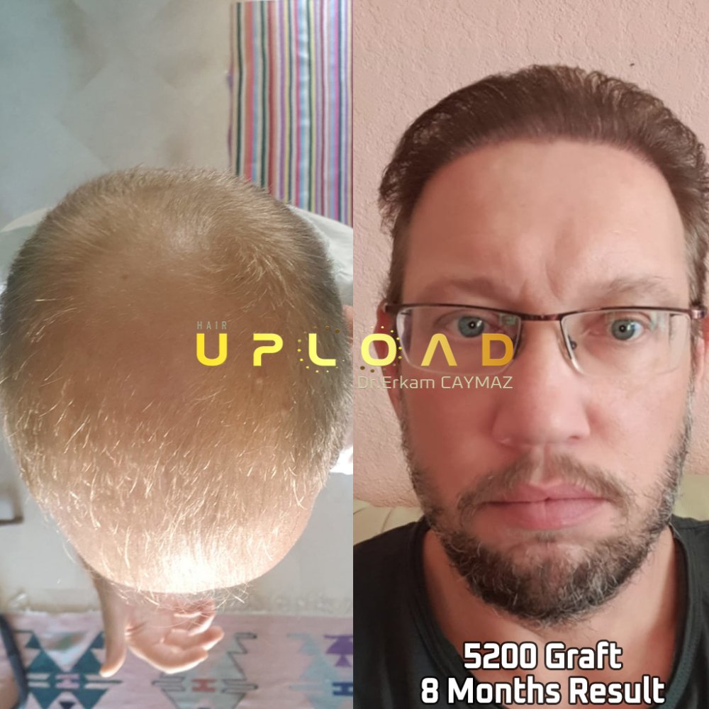 Hair transplant before & after result — frontal, parte superior, corona, 5,200 grafts, Sapphire FUE, 24 months post-op, Norwood 6 — Dr. Erkam Caymaz, Istanbul