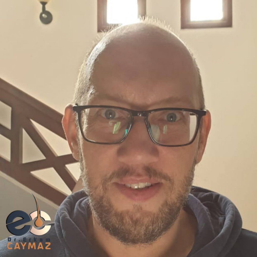 Hair transplant before & after result — frontal, parte superior, corona, 5,200 grafts, Sapphire FUE, 24 months post-op, Norwood 6 — Dr. Erkam Caymaz, Istanbul