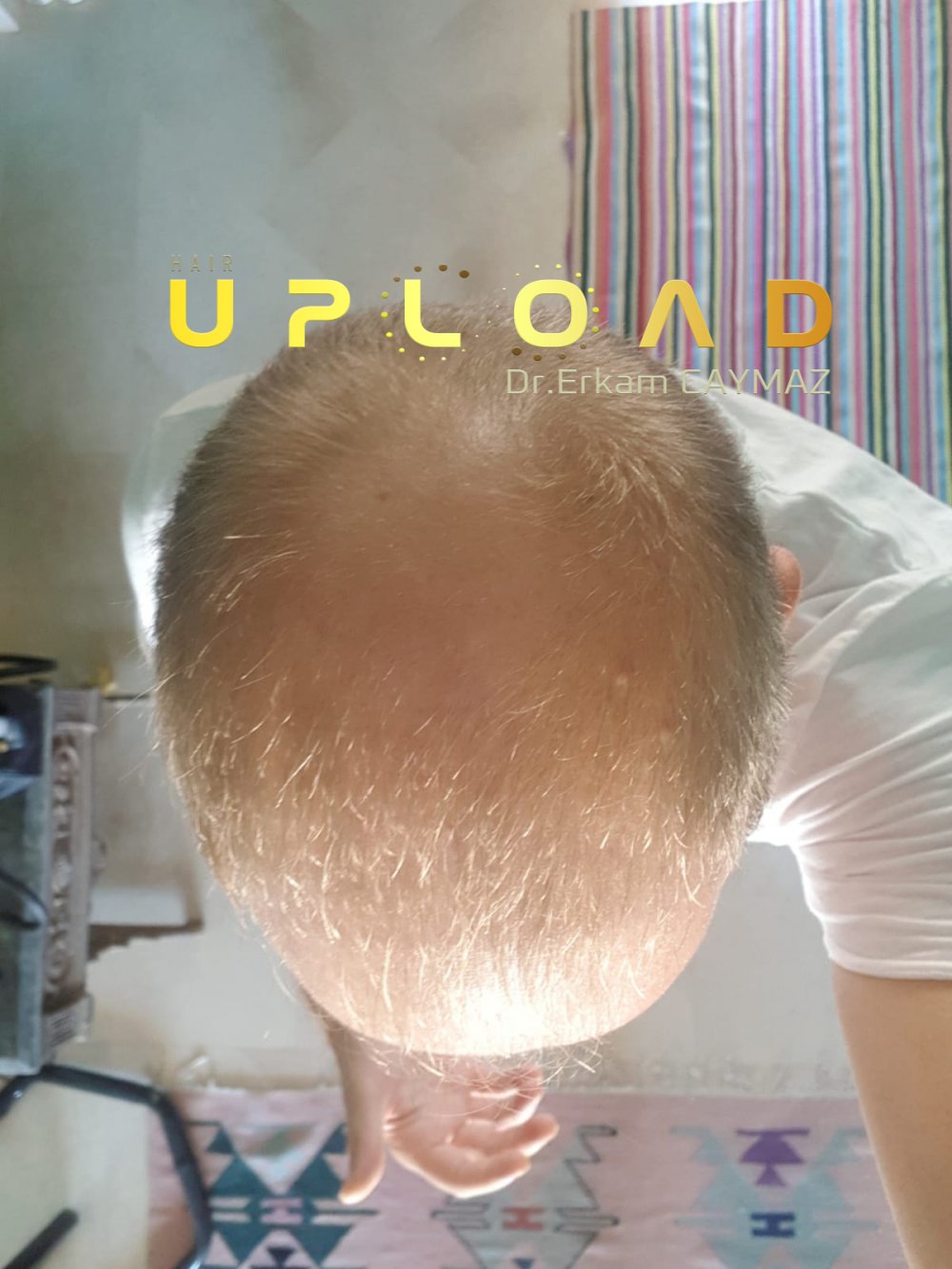 Hair transplant before & after result — frontal, parte superior, corona, 5,200 grafts, Sapphire FUE, 24 months post-op, Norwood 6 — Dr. Erkam Caymaz, Istanbul
