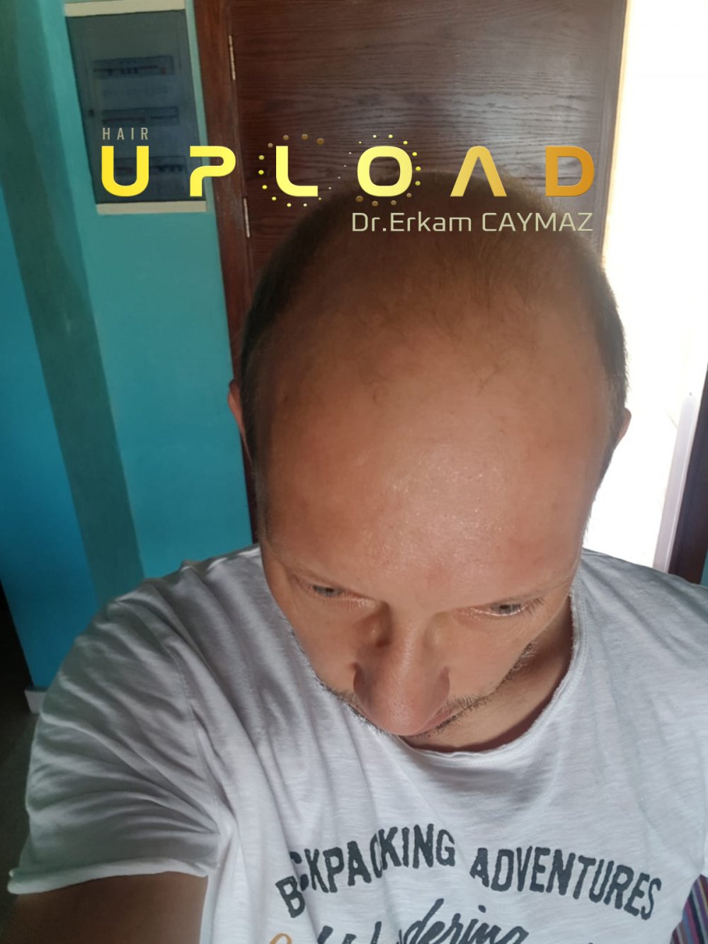 Hair transplant before & after result — frontal, parte superior, corona, 5,200 grafts, Sapphire FUE, 24 months post-op, Norwood 6 — Dr. Erkam Caymaz, Istanbul