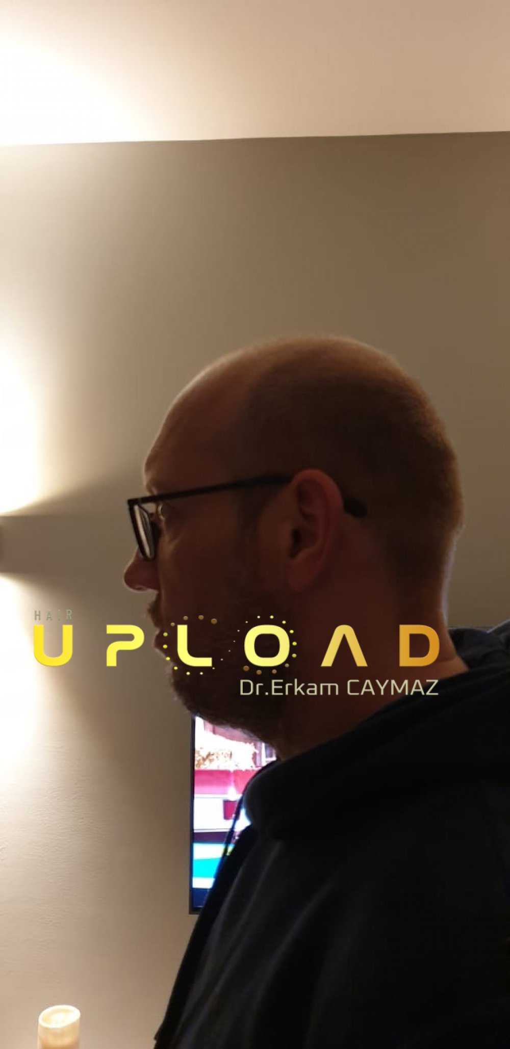 Hair transplant before & after result — frontal, parte superior, corona, 5,200 grafts, Sapphire FUE, 24 months post-op, Norwood 6 — Dr. Erkam Caymaz, Istanbul