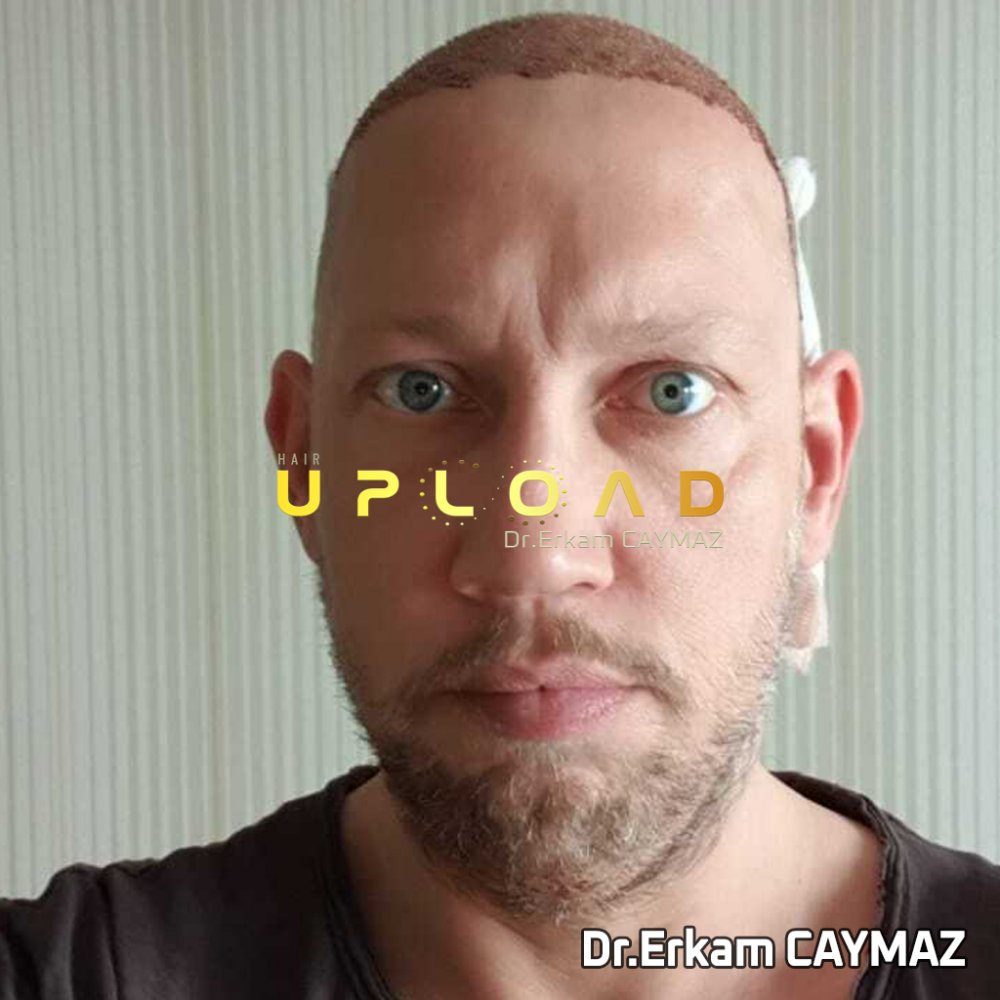 Hair transplant before & after result — frontal, parte superior, corona, 5,200 grafts, Sapphire FUE, 24 months post-op, Norwood 6 — Dr. Erkam Caymaz, Istanbul