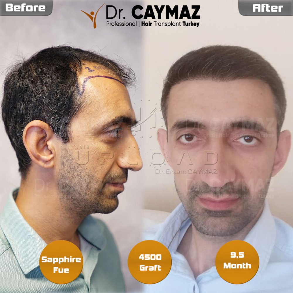 Hair transplant before & after result — frontal, parte superior, 4,500 grafts, Sapphire FUE, 10 months post-op, Norwood 4 — Dr. Erkam Caymaz, Istanbul
