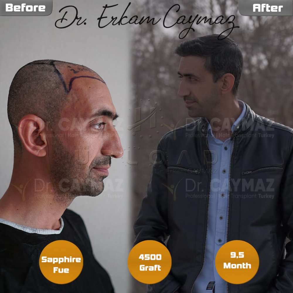 Hair transplant before & after result — frontal, parte superior, 4,500 grafts, Sapphire FUE, 10 months post-op, Norwood 4 — Dr. Erkam Caymaz, Istanbul