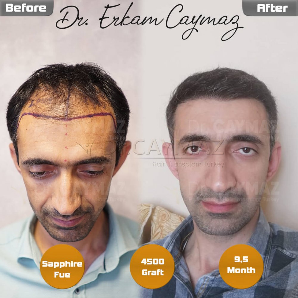 Hair transplant before & after result — frontal, parte superior, 4,500 grafts, Sapphire FUE, 10 months post-op, Norwood 4 — Dr. Erkam Caymaz, Istanbul