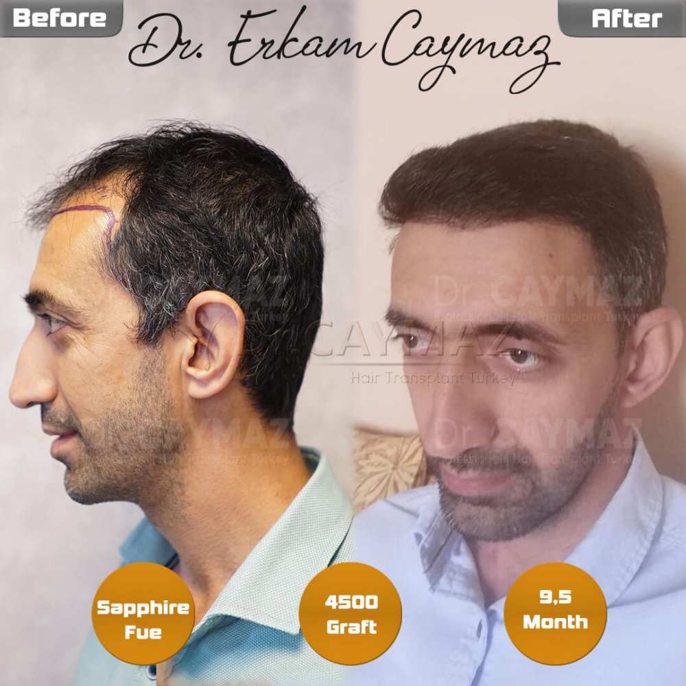 Hair transplant before & after result — frontal, parte superior, 4,500 grafts, Sapphire FUE, 10 months post-op, Norwood 4 — Dr. Erkam Caymaz, Istanbul