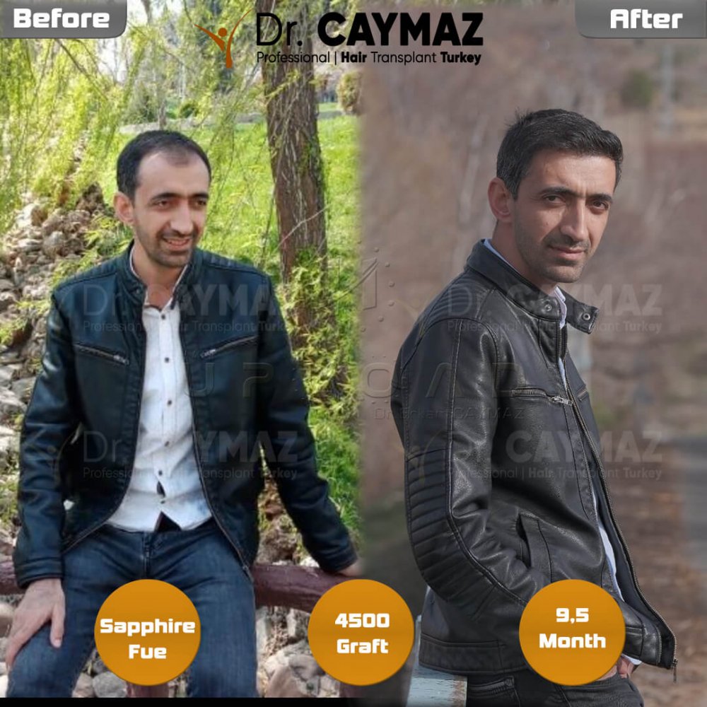 Hair transplant before & after result — frontal, parte superior, 4,500 grafts, Sapphire FUE, 10 months post-op, Norwood 4 — Dr. Erkam Caymaz, Istanbul