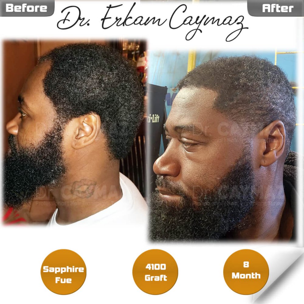 Mr.Patrick - 8 Month - 4100 Graft Afro Result — hair transplant before & after — frontal, kopfoberseite, schläfen, 4,100 grafts, Sapphire FUE, 8 months post-op, Norwood 4 — Dr. Erkam Caymaz, Istanbul