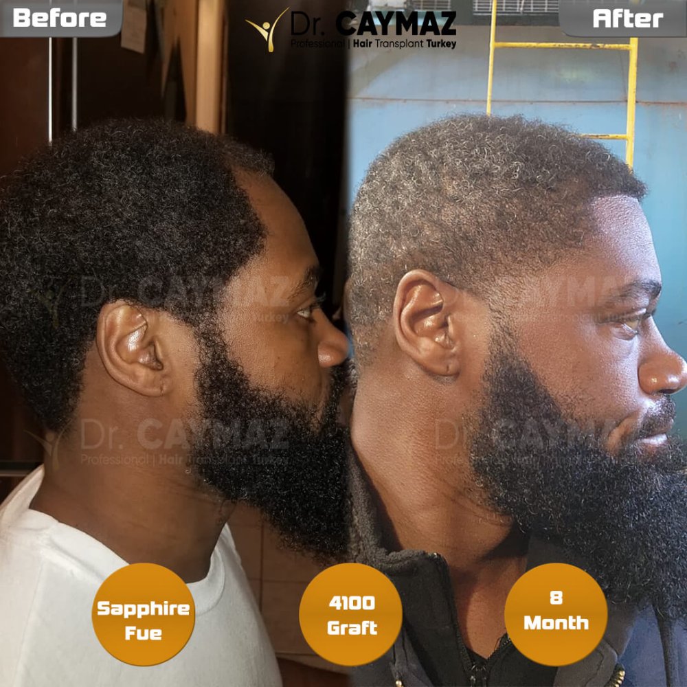 Mr.Patrick - 8 Month - 4100 Graft Afro Result — hair transplant before & after — frontal, kopfoberseite, schläfen, 4,100 grafts, Sapphire FUE, 8 months post-op, Norwood 4 — Dr. Erkam Caymaz, Istanbul