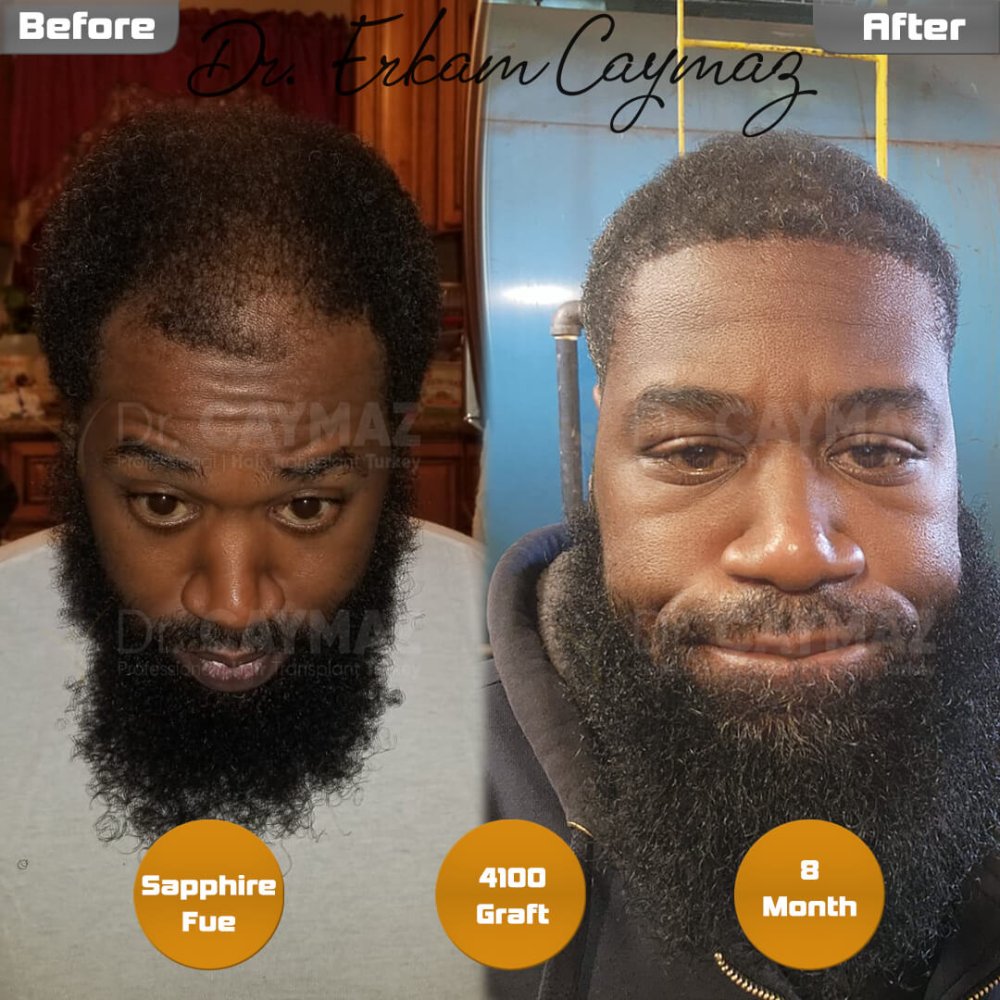Mr.Patrick - 8 Month - 4100 Graft Afro Result — hair transplant before & after — frontal, kopfoberseite, schläfen, 4,100 grafts, Sapphire FUE, 8 months post-op, Norwood 4 — Dr. Erkam Caymaz, Istanbul