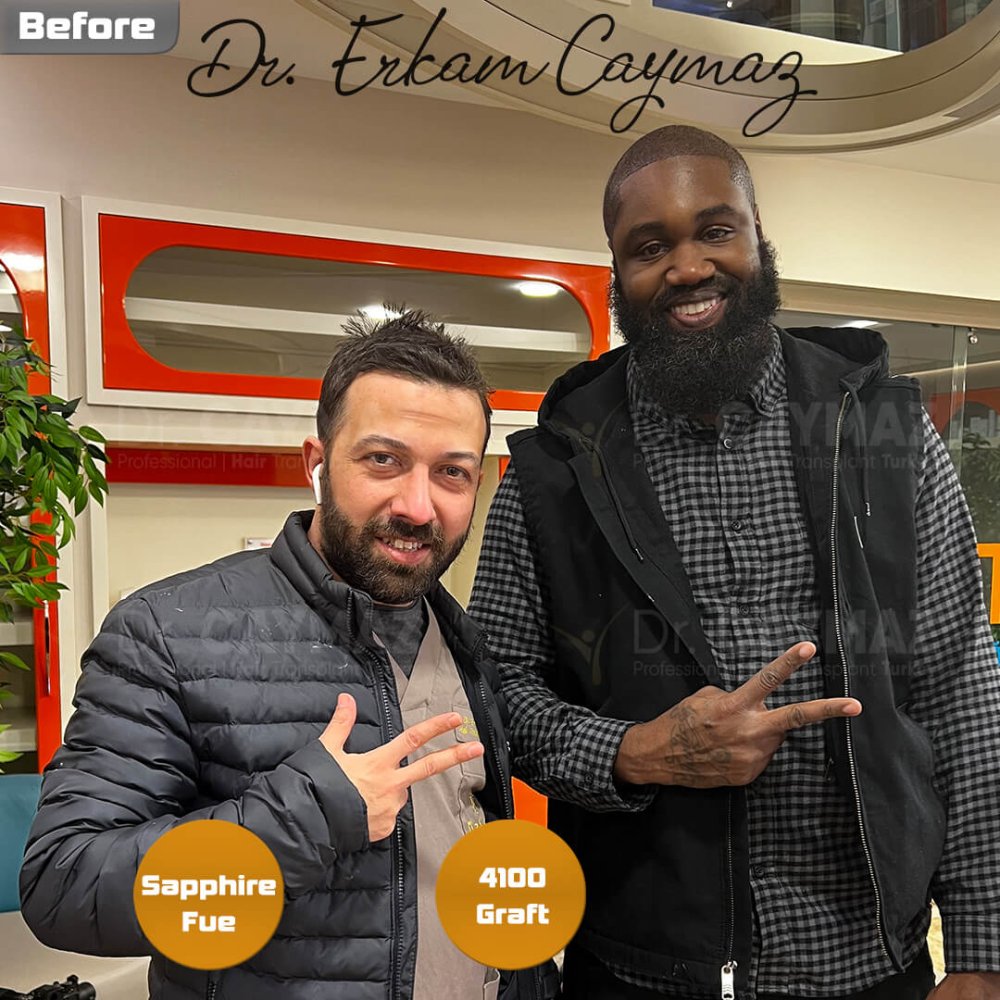 Mr.Patrick - 8 Month - 4100 Graft Afro Result — hair transplant before & after — frontal, kopfoberseite, schläfen, 4,100 grafts, Sapphire FUE, 8 months post-op, Norwood 4 — Dr. Erkam Caymaz, Istanbul