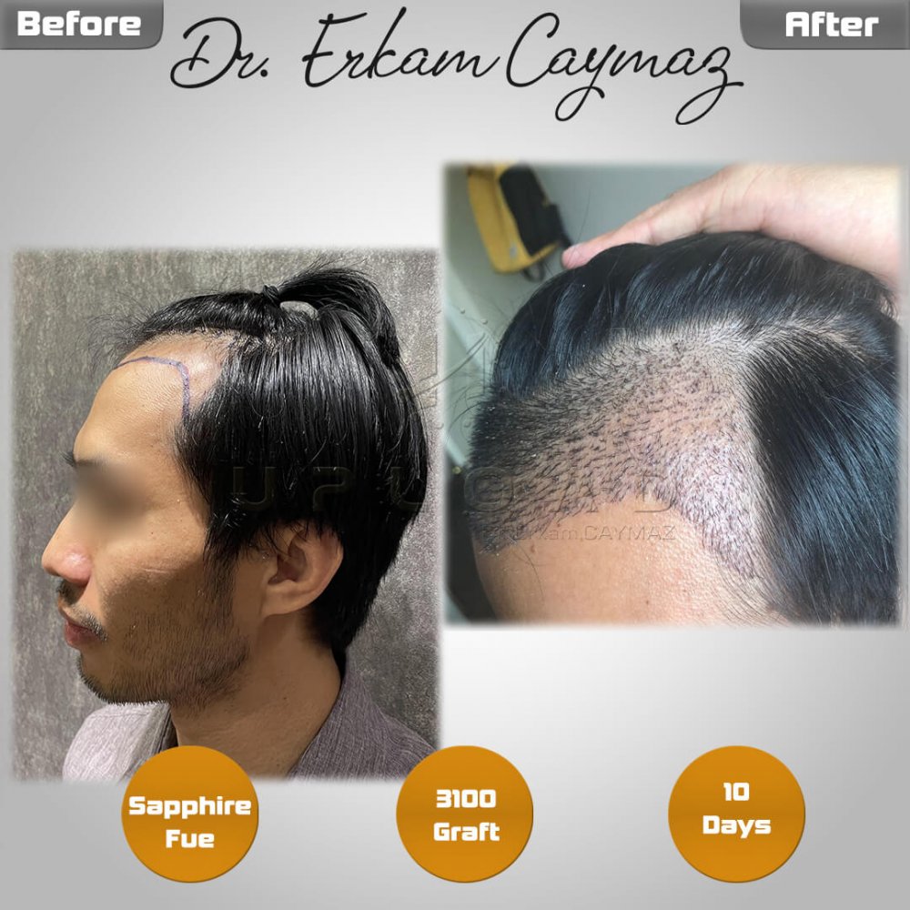 Hair transplant before & after result — sienes, Sapphire FUE, Norwood 3 — Dr. Erkam Caymaz, Istanbul