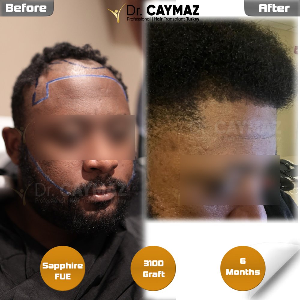 Hair transplant before & after result — frontal, schläfen, 3,100 grafts, Sapphire FUE, 6 months post-op, Norwood 3 — Dr. Erkam Caymaz, Istanbul