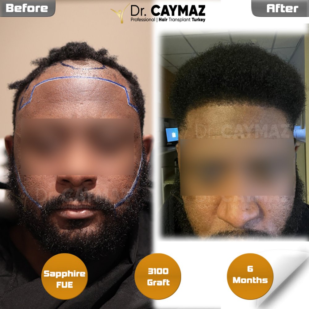 Hair transplant before & after result — frontal, schläfen, 3,100 grafts, Sapphire FUE, 6 months post-op, Norwood 3 — Dr. Erkam Caymaz, Istanbul
