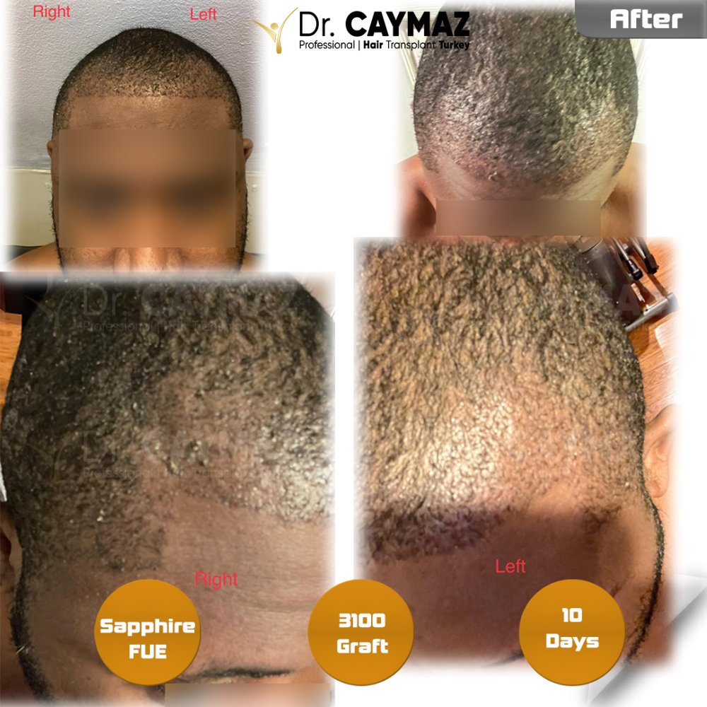 Hair transplant before & after result — frontal, schläfen, 3,100 grafts, Sapphire FUE, 6 months post-op, Norwood 3 — Dr. Erkam Caymaz, Istanbul
