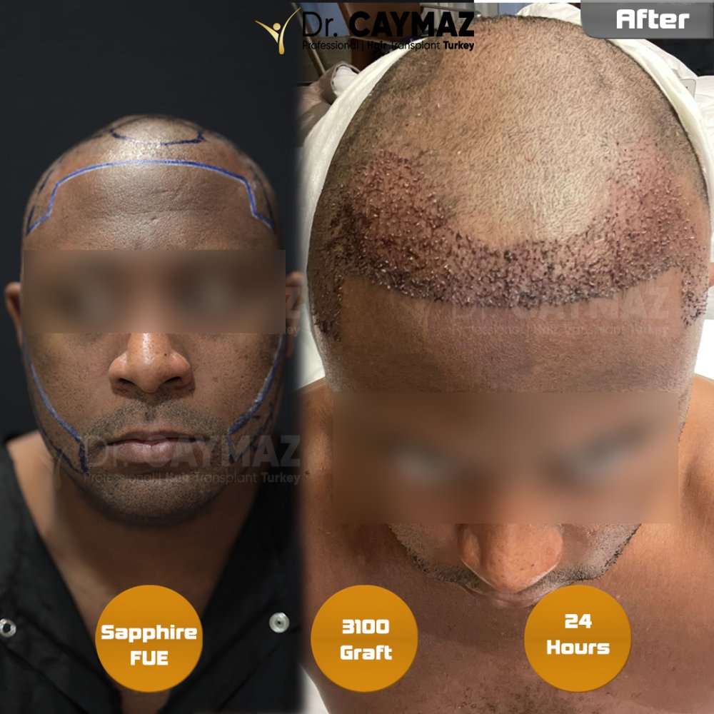 Hair transplant before & after result — frontal, schläfen, 3,100 grafts, Sapphire FUE, 6 months post-op, Norwood 3 — Dr. Erkam Caymaz, Istanbul