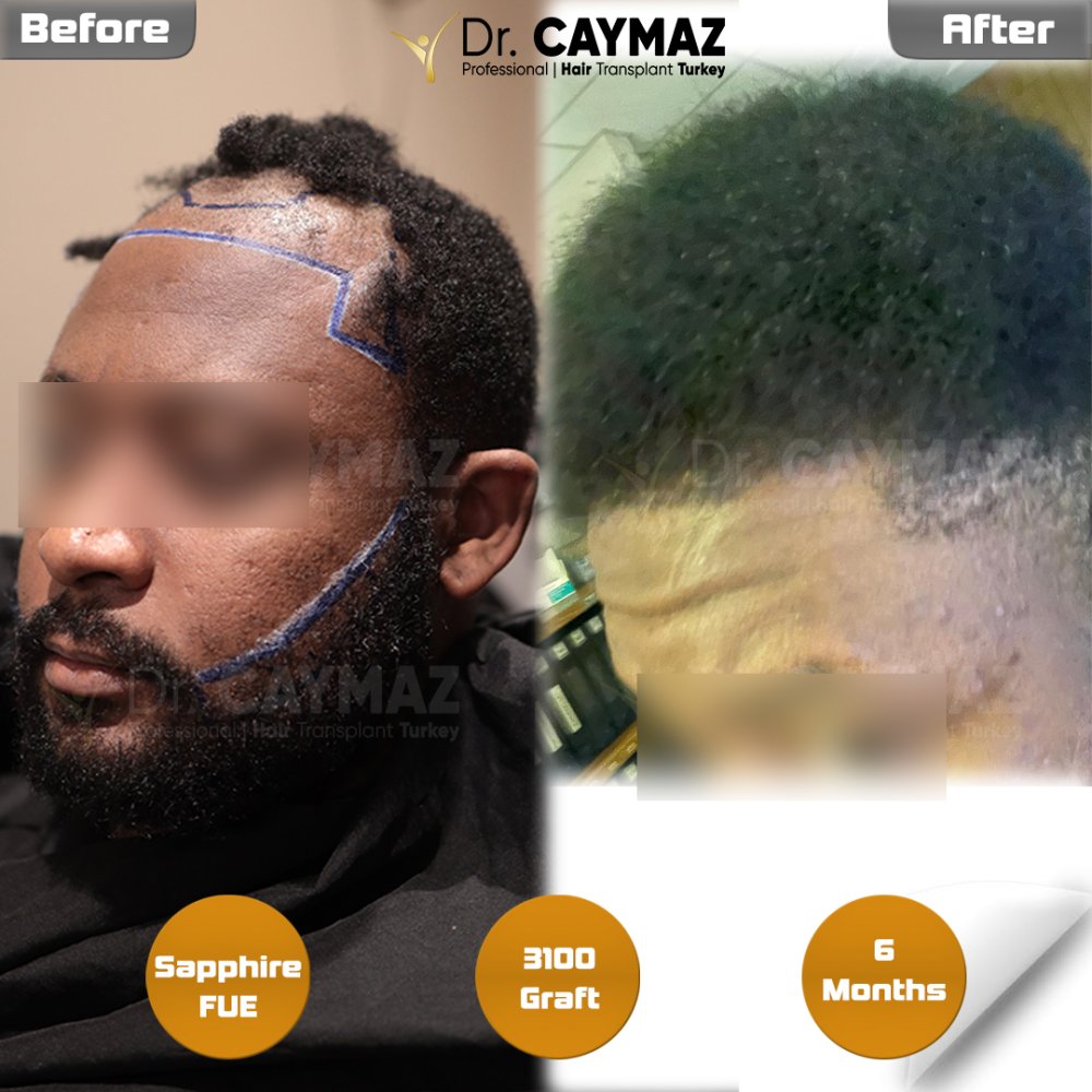 Hair transplant before & after result — frontal, schläfen, 3,100 grafts, Sapphire FUE, 6 months post-op, Norwood 3 — Dr. Erkam Caymaz, Istanbul