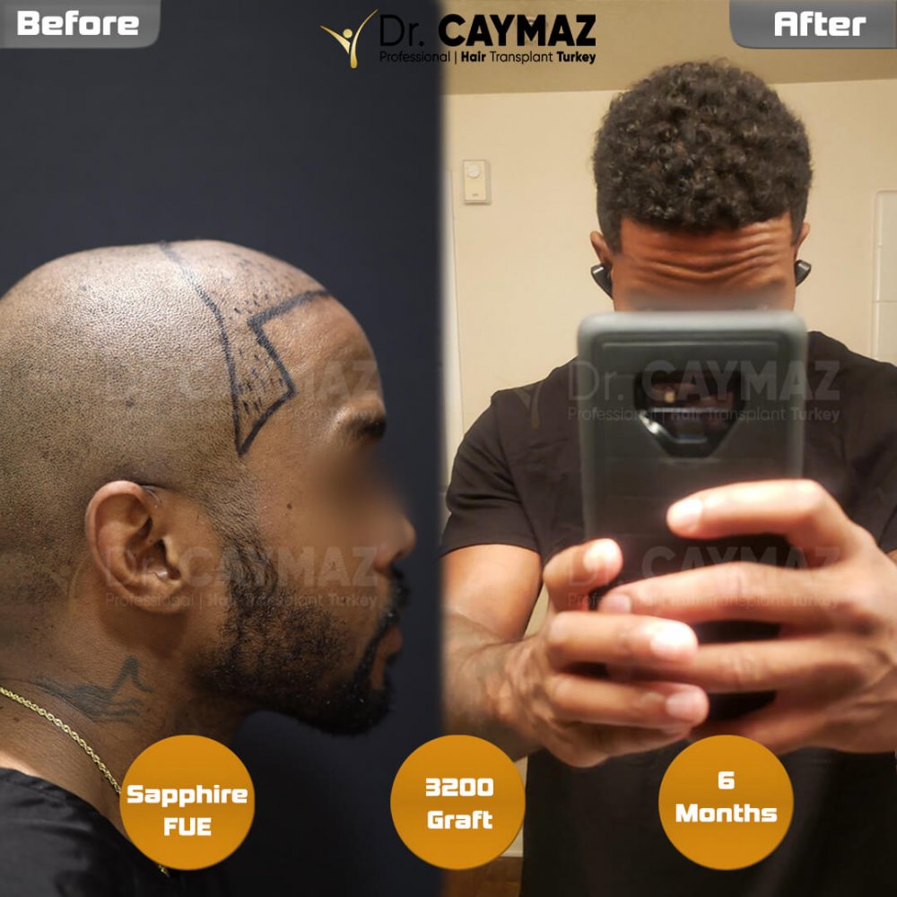 Hair transplant before & after result — frontal, 3,200 grafts, Sapphire FUE, 6 months post-op, Norwood 3 — Dr. Erkam Caymaz, Istanbul
