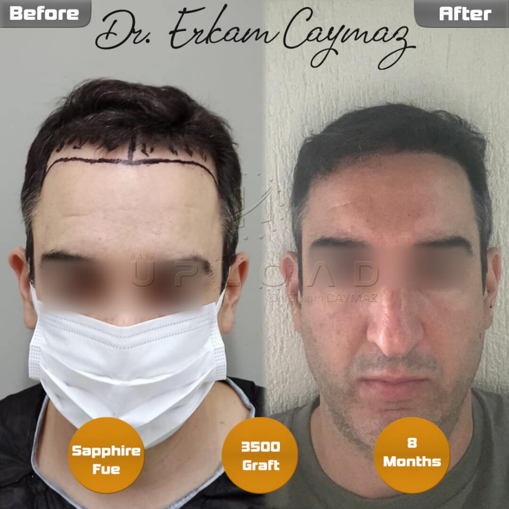 Hair transplant before & after result — frontal, crown, 3,500 grafts, Sapphire FUE, 8 months post-op, Norwood 3 — Dr. Erkam Caymaz, Istanbul