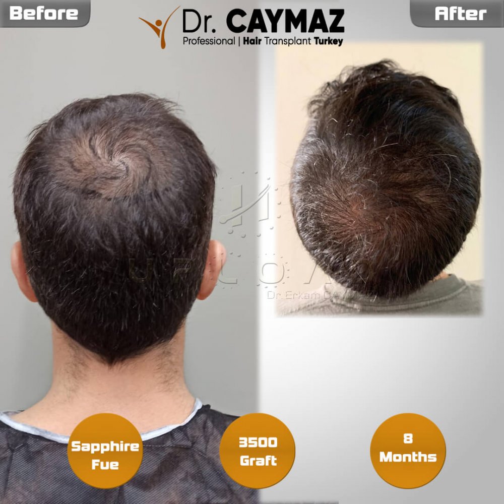 Hair transplant before & after result — frontal, crown, 3,500 grafts, Sapphire FUE, 8 months post-op, Norwood 3 — Dr. Erkam Caymaz, Istanbul