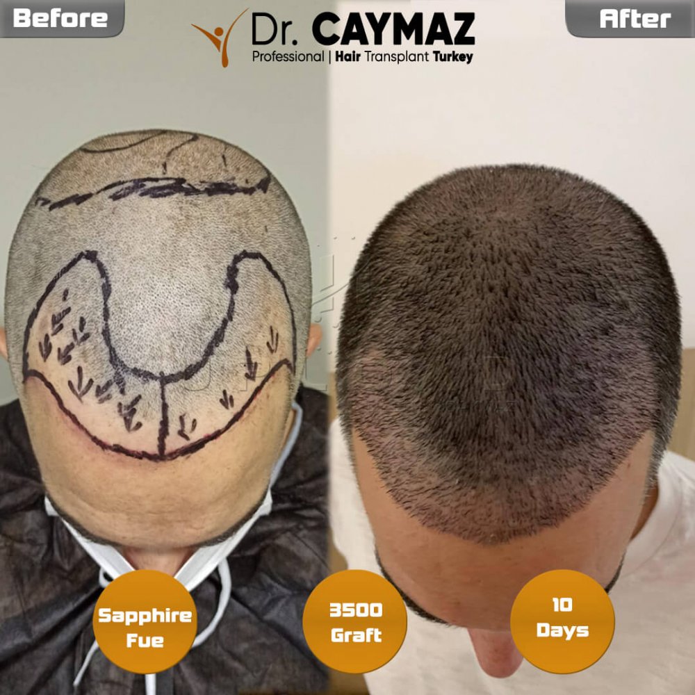 Hair transplant before & after result — frontal, crown, 3,500 grafts, Sapphire FUE, 8 months post-op, Norwood 3 — Dr. Erkam Caymaz, Istanbul