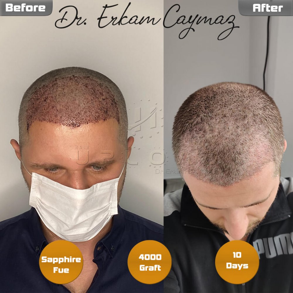 Hair transplant before & after result — frontal, 4,000 grafts, Sapphire FUE, 9 months post-op, Norwood 3 — Dr. Erkam Caymaz, Istanbul