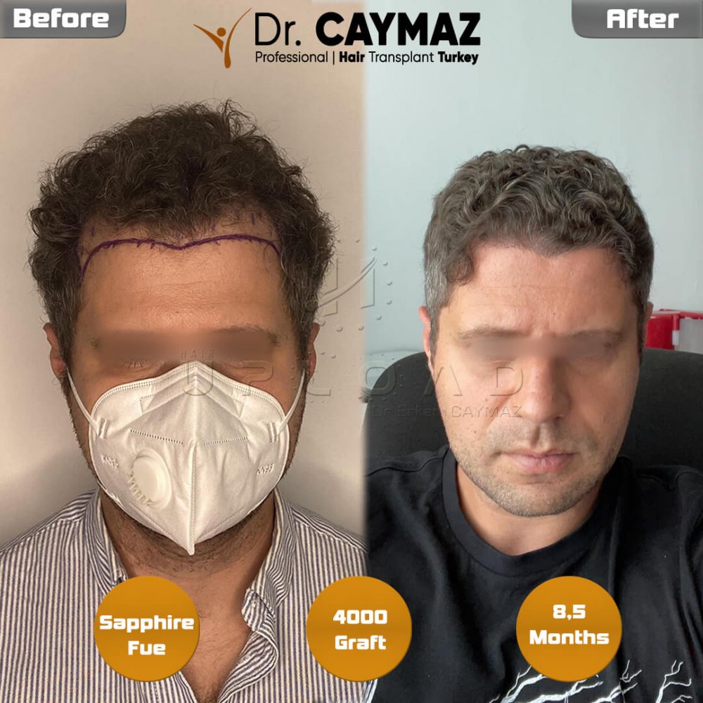 Hair transplant before & after result — frontal, 4,000 grafts, Sapphire FUE, 9 months post-op, Norwood 3 — Dr. Erkam Caymaz, Istanbul