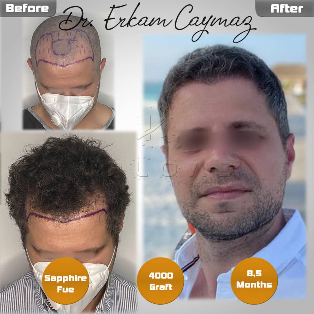 Hair transplant before & after result — frontal, 4,000 grafts, Sapphire FUE, 9 months post-op, Norwood 3 — Dr. Erkam Caymaz, Istanbul
