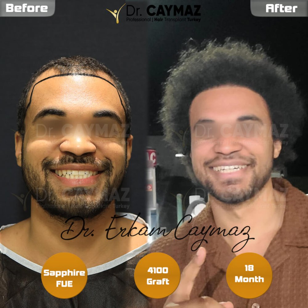 Hair transplant before & after result — frontal, kopfoberseite, kronenregion, 4,100 grafts, Sapphire FUE, 18 months post-op, Norwood 4 — Dr. Erkam Caymaz, Istanbul