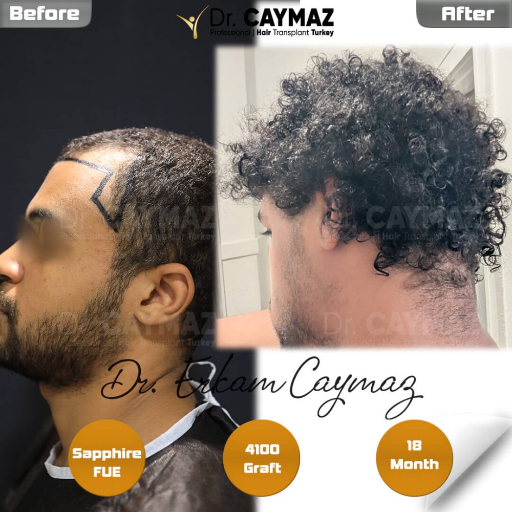 Hair transplant before & after result — frontal, kopfoberseite, kronenregion, 4,100 grafts, Sapphire FUE, 18 months post-op, Norwood 4 — Dr. Erkam Caymaz, Istanbul