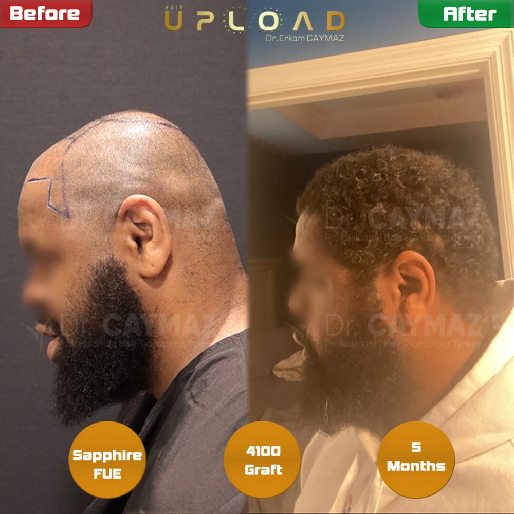 Mr.Private - Afro - 4100 Graft - 5 Months Sapphire Result — hair transplant before & after — frontal, top of head, 4,100 grafts, Sapphire FUE, 5 months post-op, Norwood 4 — Dr. Erkam Caymaz, Istanbul