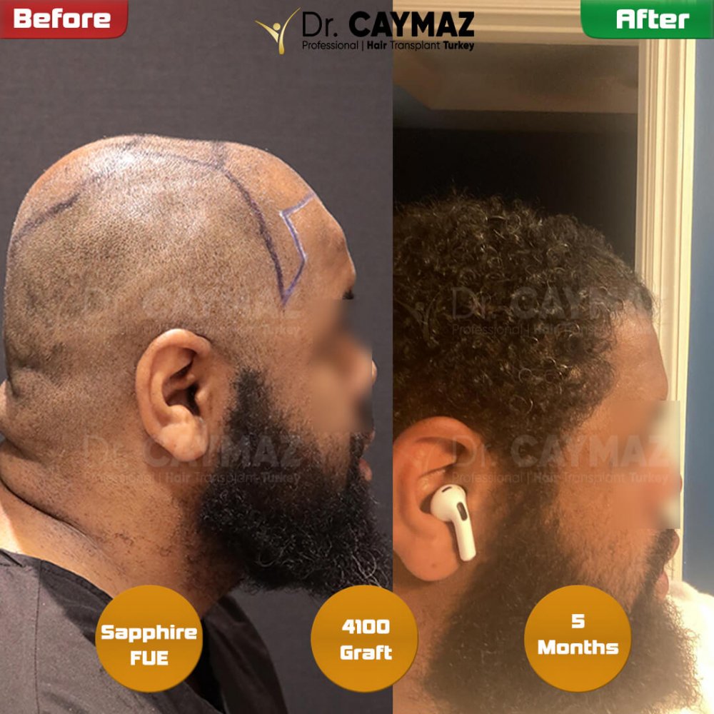 Mr.Private - Afro - 4100 Graft - 5 Months Sapphire Result — hair transplant before & after — frontal, top of head, 4,100 grafts, Sapphire FUE, 5 months post-op, Norwood 4 — Dr. Erkam Caymaz, Istanbul
