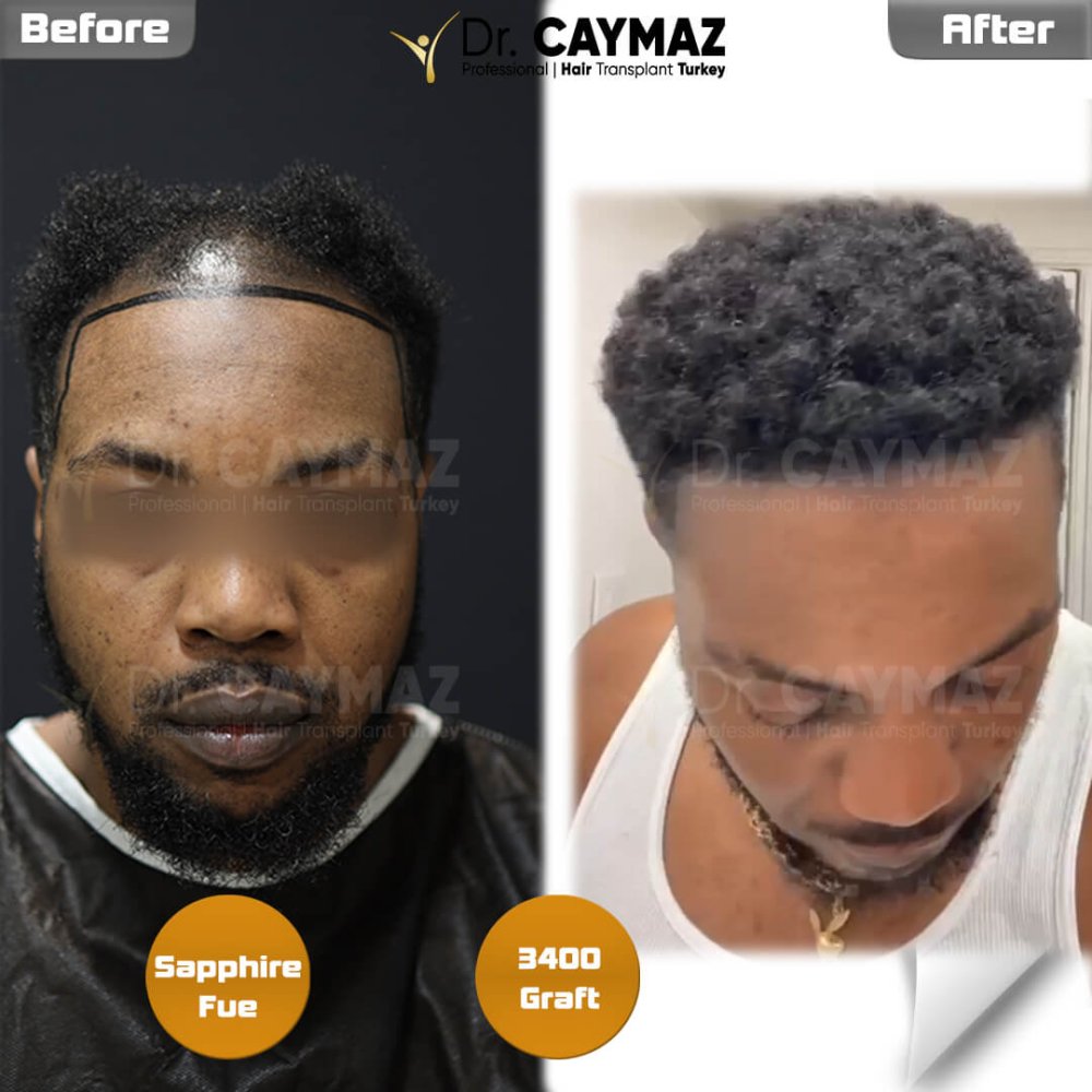 Hair transplant before & after result — frontal, kopfoberseite, schläfen, 3,400 grafts, Sapphire FUE, 12 months post-op, Norwood 4 — Dr. Erkam Caymaz, Istanbul