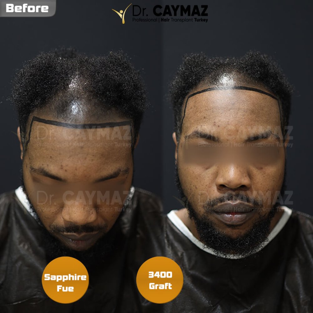 Hair transplant before & after result — frontal, kopfoberseite, schläfen, 3,400 grafts, Sapphire FUE, 12 months post-op, Norwood 4 — Dr. Erkam Caymaz, Istanbul