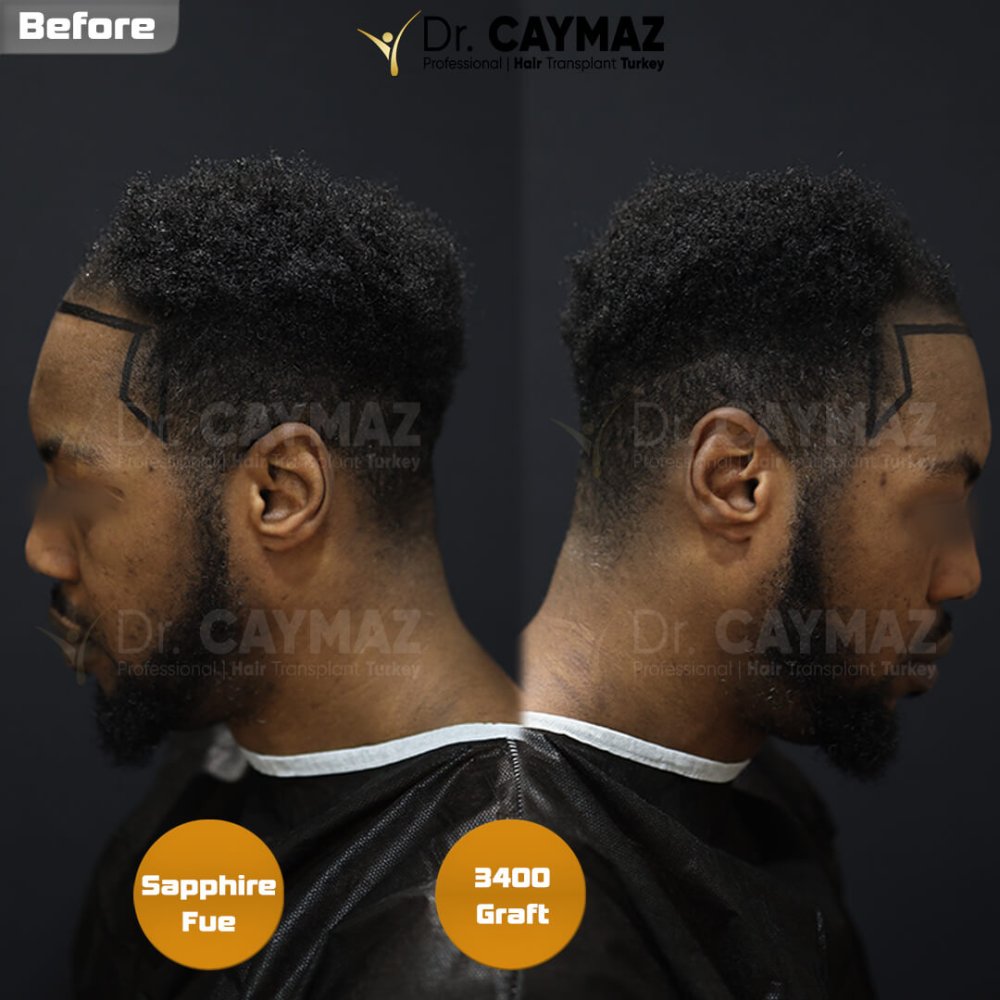 Hair transplant before & after result — frontal, kopfoberseite, schläfen, 3,400 grafts, Sapphire FUE, 12 months post-op, Norwood 4 — Dr. Erkam Caymaz, Istanbul