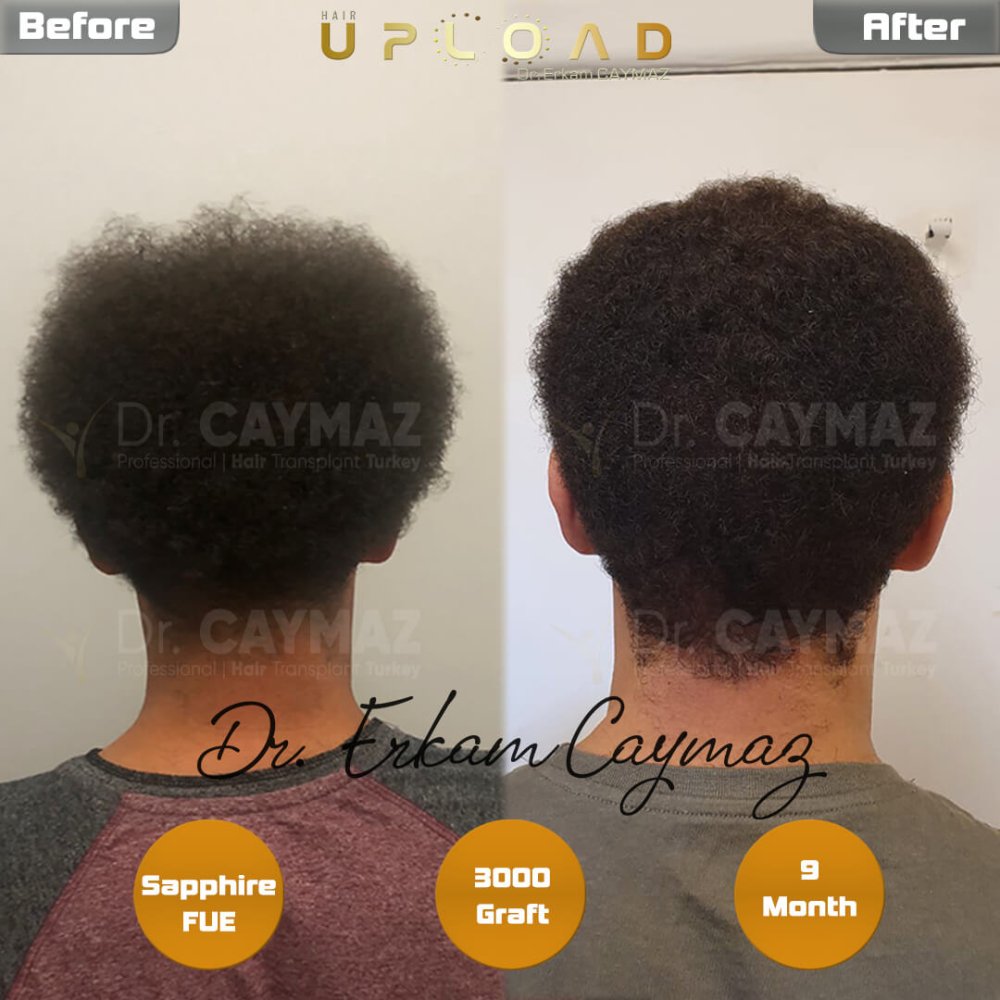 Hair transplant before & after result — frontal, 3,000 grafts, Sapphire FUE, 9 months post-op, Norwood 3 — Dr. Erkam Caymaz, Istanbul